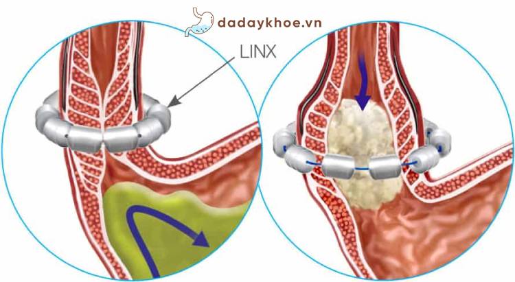 Phẫu thuật tăng cường cơ thắt thực quản dưới (Linx) 1