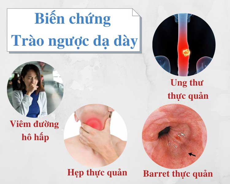 Chắc chắn bạn chưa hiểu hết về trào ngược dạ dày thực quản 2