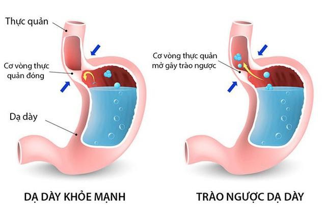 Chắc chắn bạn chưa hiểu hết về trào ngược dạ dày thực quản 1