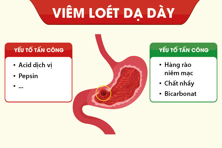 Chắc chắn bạn chưa biết hết về bệnh trào ngược dạ dày và đau dạ dày 2